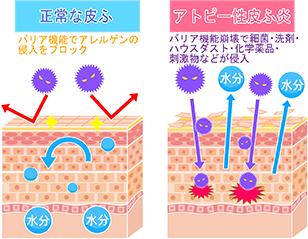 アトピー性皮膚炎が発症するメカニズム