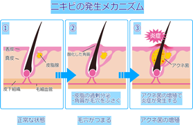 ニキビの発生メカニズム